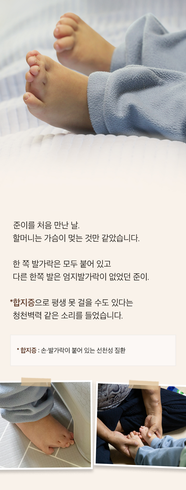발가락이 붙어 태어난 아이